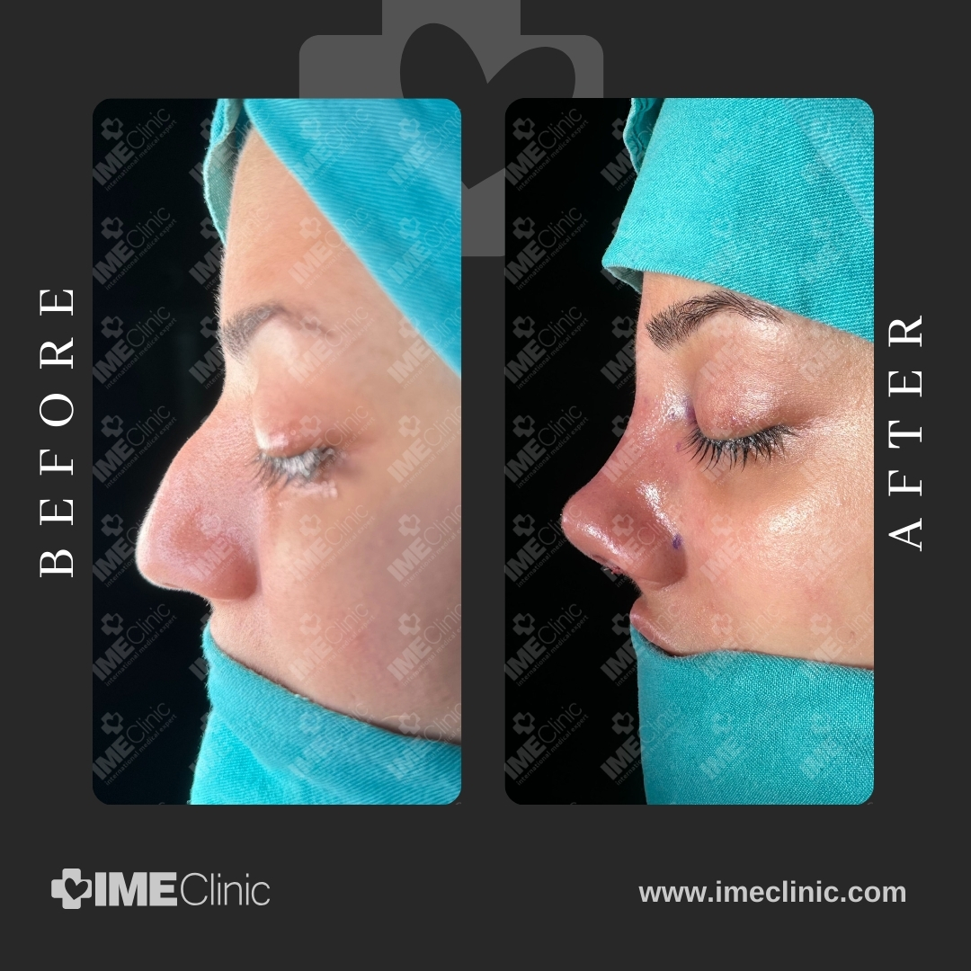 
                                     Side-by-side comparison of a persons nose before and after a cosmetic procedure. The left image shows the nose with a more prominent profile, while the right image depicts a smoother profile. Both images have a watermark of IMEClinic.